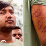 CJP protest: India’s ‘Cockroach’ protesters have wounds consistent with pellet-gun fire, experts say