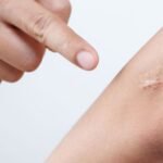 Can you make scars fade? Doctors explain why they form and what works – from silicone sheets to Vitamin E