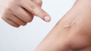 Can you make scars fade? Doctors explain why they form and what works – from silicone sheets to Vitamin E