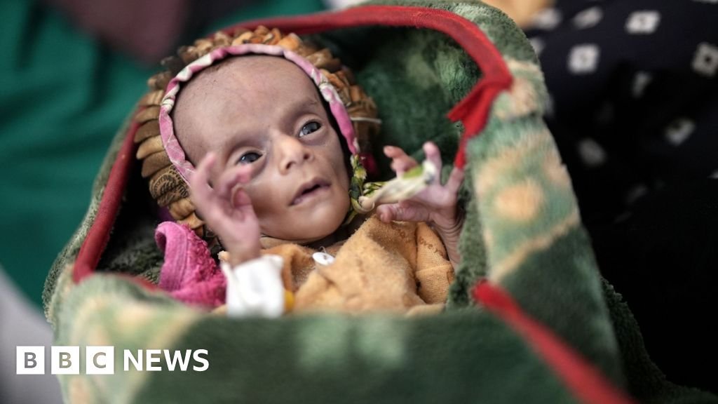 Newborn twins fight for survival as conflict fuels Yemen’s hunger crisis