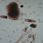 The latest outbreaks of so-called ‘flesh-eating bacteria’