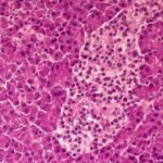 Pancreatic cancer: New drug extends lives but isn’t a cure