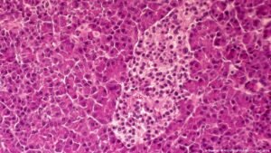 Pancreatic cancer: New drug extends lives but isn’t a cure