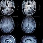 Brain tumors: New vaccine offers patients hope for more time