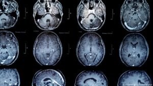 Brain tumors: New vaccine offers patients hope for more time