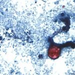 US sees mysterious spread of cyclospora diarrhea parasite