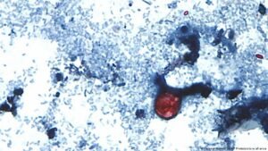 US sees mysterious spread of cyclospora diarrhea parasite