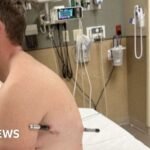 Man impaled by a hiking pole treks 10 miles down mountain
