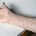 Singapore’s measles cases reach six-year high, three vaccinated cases among 40 infections