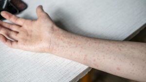 Singapore’s measles cases reach six-year high, three vaccinated cases among 40 infections