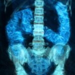 Bowel cancer rates rising in Latin America: Is it linked to obesity?