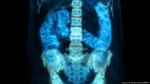 Bowel cancer rates rising in Latin America: Is it linked to obesity?